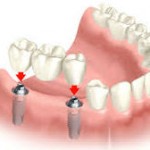 dental bridge 3 crowns ober tooth implants