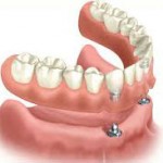 denture over 2 tooth implants