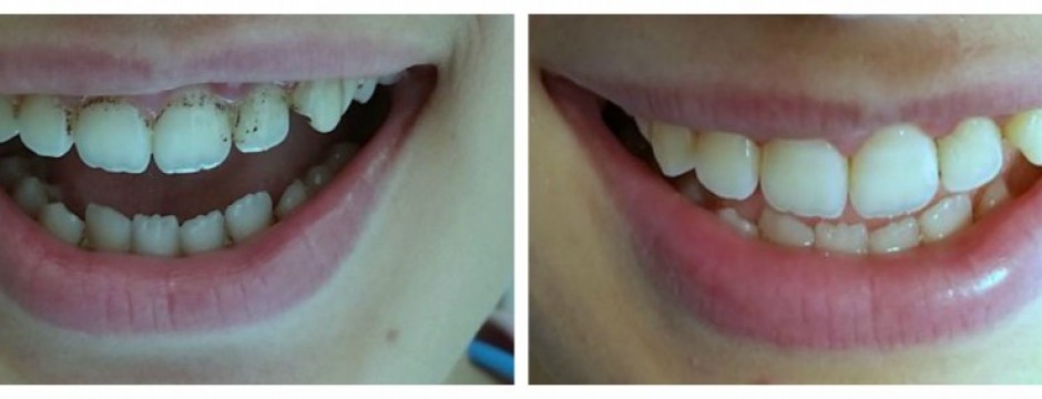 teeth cleaning, teeth scaling, dentist abroad, dentist greece, dentist crete , dentist hersonissos, dentist malia, stalis, analipsi, piscopiano, koutouloufari, Chersonisos