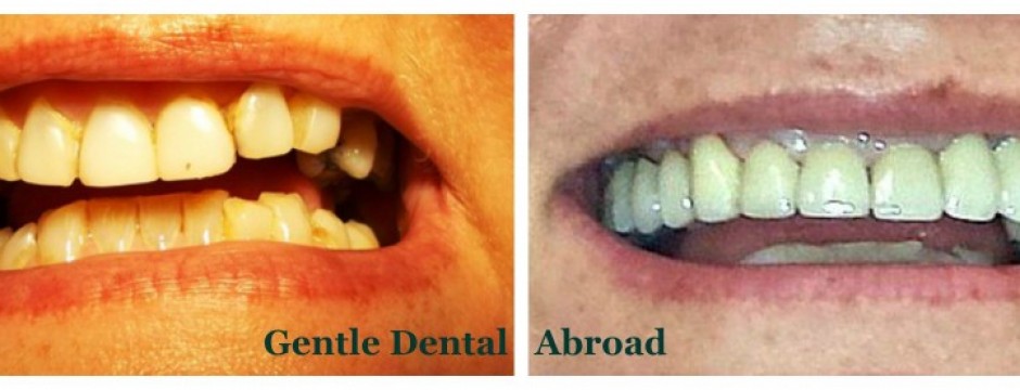 dental crowns, teeth crowns, teeth caps, teeth bridge , dentist abroad, low cost dental crowns,low cost dental crowns, cheap dental bridge,porcelain crown, porcelain bridge,dentist abroad, dentist greece, dentist crete , dentist hersonissos, dentist malia, stalis, analipsi, piscopiano, koutouloufari, Chersonisos, gouves