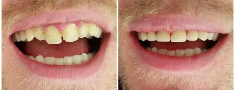 dentist abroad, dental holiday, dentist greece, dentist crete , dentist hersonissos, dentist malia, stalis, analipsi, piscopiano, koutouloufari, Chersonisos, gouves