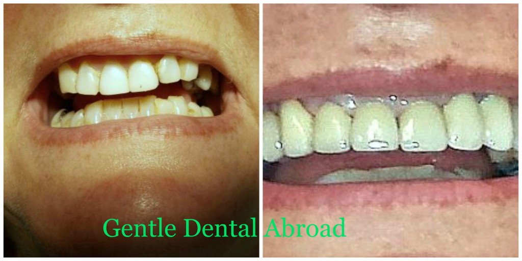 Cosmetic Dentist in Greece Before & After Dental Treatment Pictures