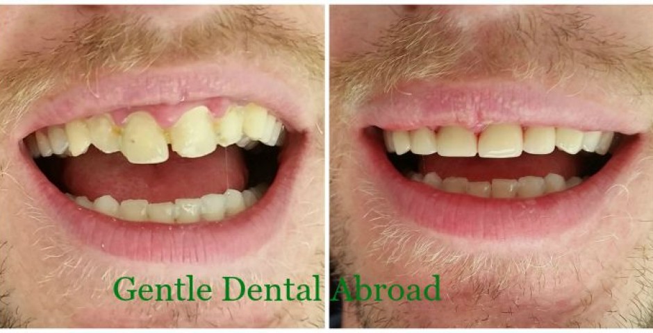 Greece dentist, Greece medical tourism, dentist prices greece, Greece dental tourism, Greece dental implants, tooth implants Greece, tooth implant Greece, cosmetic dentist in greece, tooth crown Greece, teeth implants, Greece teeth implant, Greece teeth crown, Greece teeth bridge, Greece medical tourism Greece, greek medical tourism, Greece tooth implants, Greece tooth implant, Greece tooth crown, Greece teeth implants, Greece teeth implant, Greece teeth crown, Greece teeth bridge, Greece dental veneers, Greece dental surgery, Greece dental practice, Greece dental implant, Greece dental house, Greece dental Crown, Greece dental clinic, Greece dental bridge, Greece dental, dentist Greece, dental veneers Greece, dental tourism greece, dental surgery Greece, dental practice Greece, dental implants Greece, dental implant Greece, dental house Greece, dental Crown Greece, dental cost greece, dental clinic Greece, dental bridge Greece