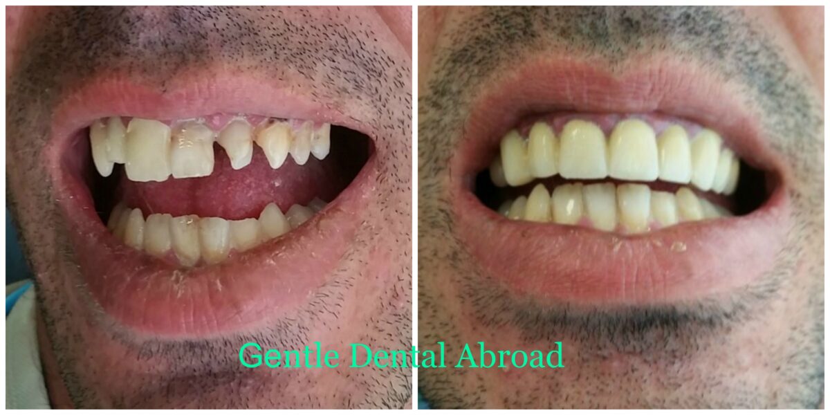 Cosmetic Dentist in Greece Before & After Dental Treatment Pictures