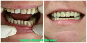 dentist abroad, dentist greece, dental tourism greece, medical tourism greece, dental crown abroad