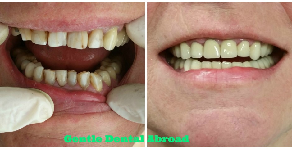 dentist abroad, dentist greece, dental tourism greece, medical tourism greece, dental crown abroad