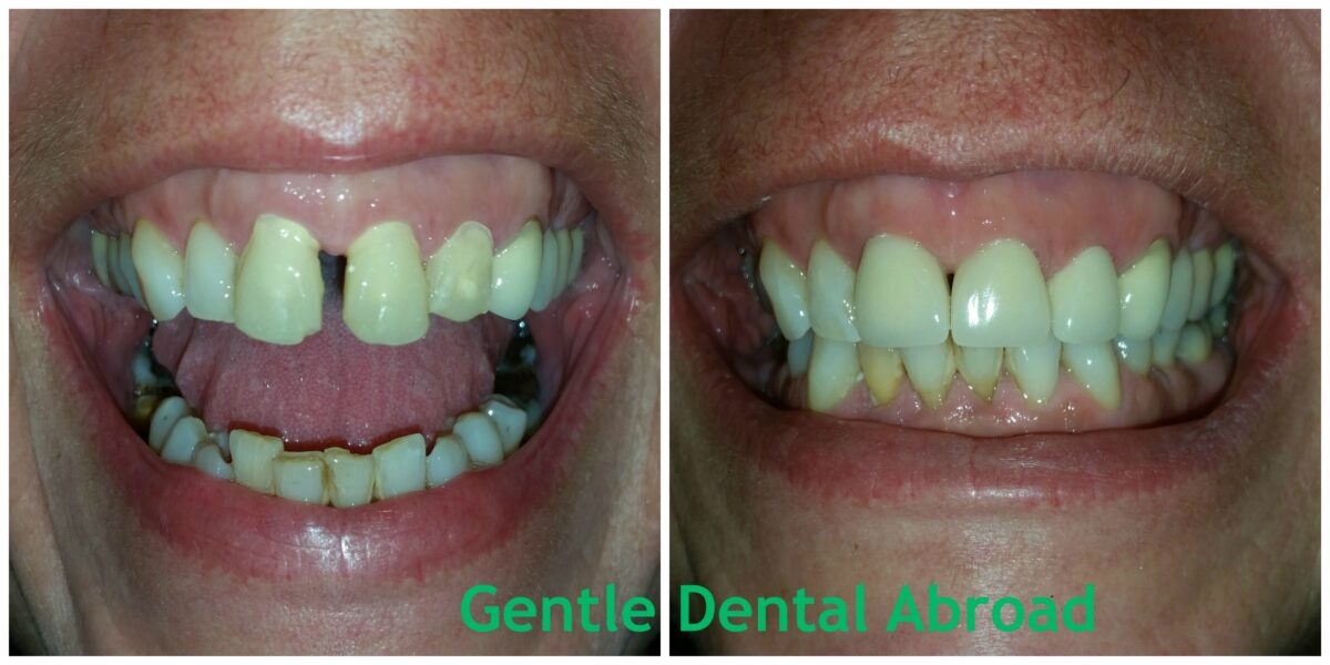 Cosmetic Dentist in Greece Before & After Dental Treatment Pictures