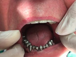 dental crowns, porcelain crowns, dental vacation, best dental vacation, dentist greece